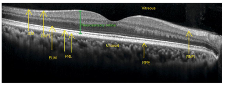 An OCT scan of a normal retina